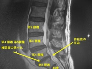 脊柱管狭窄症　7つの原因